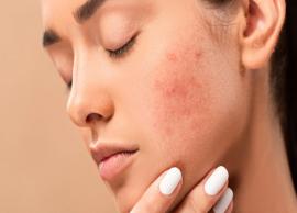 6 Beauty Tip To Help You Get Rid of Acne Scars