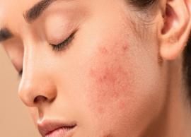 5 Effective Home Remedies To Treat Acne Scars