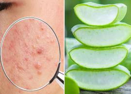6 Ways To Get Rid of Acne and Scars With Aloe Vera