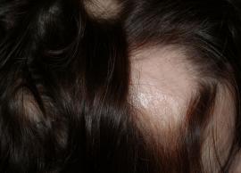 Home Remedies To Treat Hair Problem Alopecia