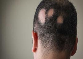 5 Alopecia Areata Symptoms You Should Not Ignore