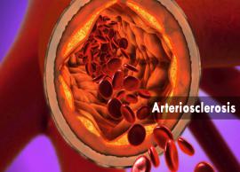 10 Remedies To Help You Cure Arteriosclerosis