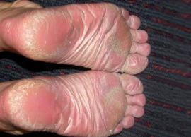 5 Essential Oils You Can Use To Treat Athele's Foot