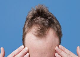 Baldness is Quite Worrying, Let us Look at Some Baldness Treatment Home Remedies