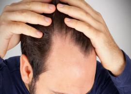 6 Home Remedies To Treat Baldness