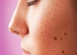 Home Remedies To Get Rid of Black Spots From Face