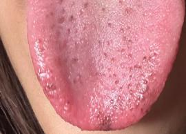 8 Ways to Get Rid of Black Spots on the Tongue Naturally