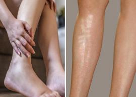 Got Dark Spots and Scars on Your Legs? Here's How You Can Get Rid of Them