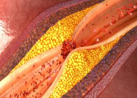 3 Remedies You Can Try for Blocked Arteries