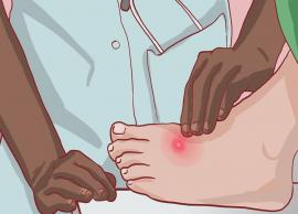 7 Home Remedies To For Treating Boils and Abscesses