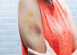 5 Remedies To Help You Heal Bruises