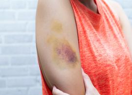 6 Home Remedies To Help You Treat Bruises