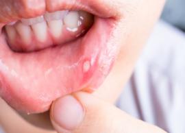 5 Remedies To Help You Get Rid of Canker Sores
