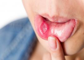 5 Home Remedies To Get of Canker Sores