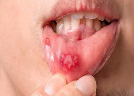 6 Effective Home Remedies To Treat Canker Sores