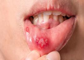 18 Natural Remedies To Treat Canker Sores