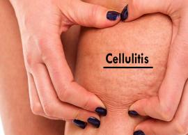 20 Best and Effective Remedies To Reduce Cellulitis