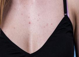 5 Home Remedies To Get Rid of Chest Acne