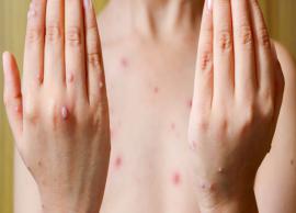 Effective Home Remedies To Treat Chickenpox Easily 