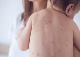 Know The Symptoms, Causes and Home Remedies of Chicken Pox