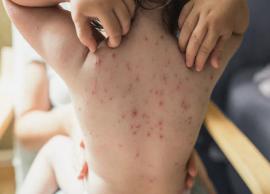7 Home Remedies That are Beneficial for Chickenpox Treatment
