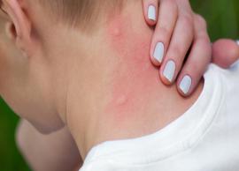 6 Must Try Home Remedies To Get Rid of Chigger Bites