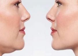 5 Ways Effective To Help You Get Rid of Double Chin
