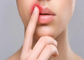 18 Home Remedies for Cold Sores