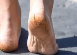 5 Easy and Natural Ways To Treat Cracked Heels