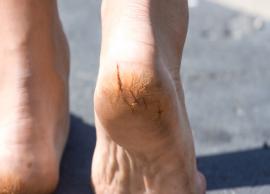 5 Easy Ways That Help You To Heal Cracked Heels