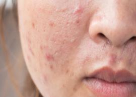 8 Home Remedies To Treat Cystic Acne