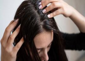 6 DIY Ways To Control Dandruff During Winters