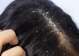 6 Remedies You Can Follow at Home as a Dandruff Treatment