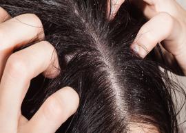 Check Out These Easy Remedies To Treat Dandruff Problem