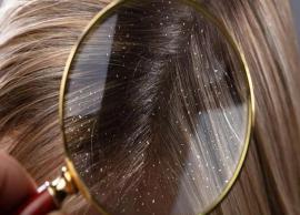 13 Home Remedies to Control and Mitigate the Risk of Dandruff