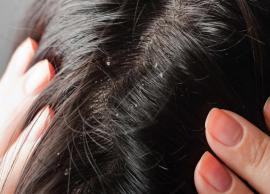 6 Natural Ways To Help You Get Rid of Dandruff