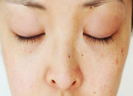 5 Home Remedies to Get Rid of Dark Spots