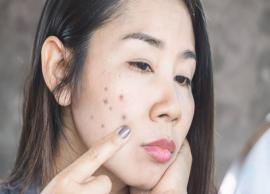 5 Quick Remedies To Treat Dark Spots at Home