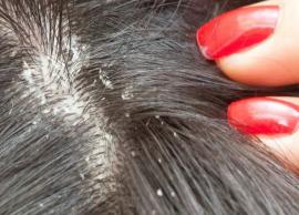 5 Home Remedies to Treat Dry Scalp