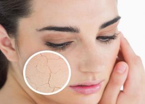 4 Ways To Treat Dry Skin