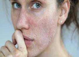 6 Must Try Herbs To Treat Dry Skin