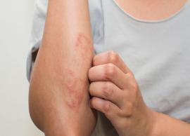 5 Home Remedies To Treat Eczema
