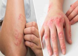 9 Remedies To Treat Eczema Naturally at Home