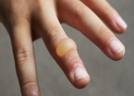 10 Ways To Treat Finger Burns at Home