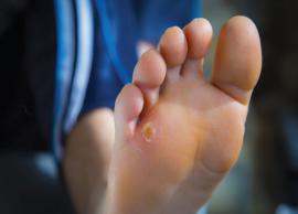 6 Effective Home Remedies for Foot Corns