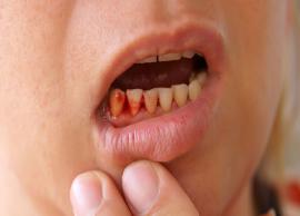 5 Natural Ways To Treat Gum Bleeding at Home