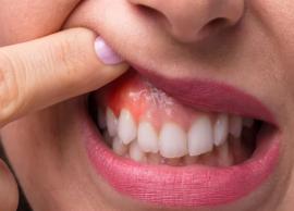 5 Home Remedies To Treat Gum Pain

