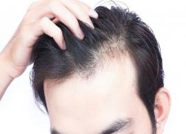 5 Natural Ways To Treat Hair Baldness