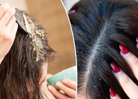 10 DIY Masks To Help You Get Rid of Dandruff Quickly