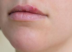 Know The Causes and Treatment of Herpes